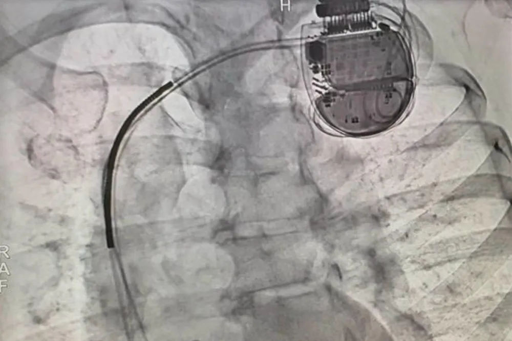Implante de marcapasos definitivo, desfibrilador automático implantable o resincronizador cardíaco